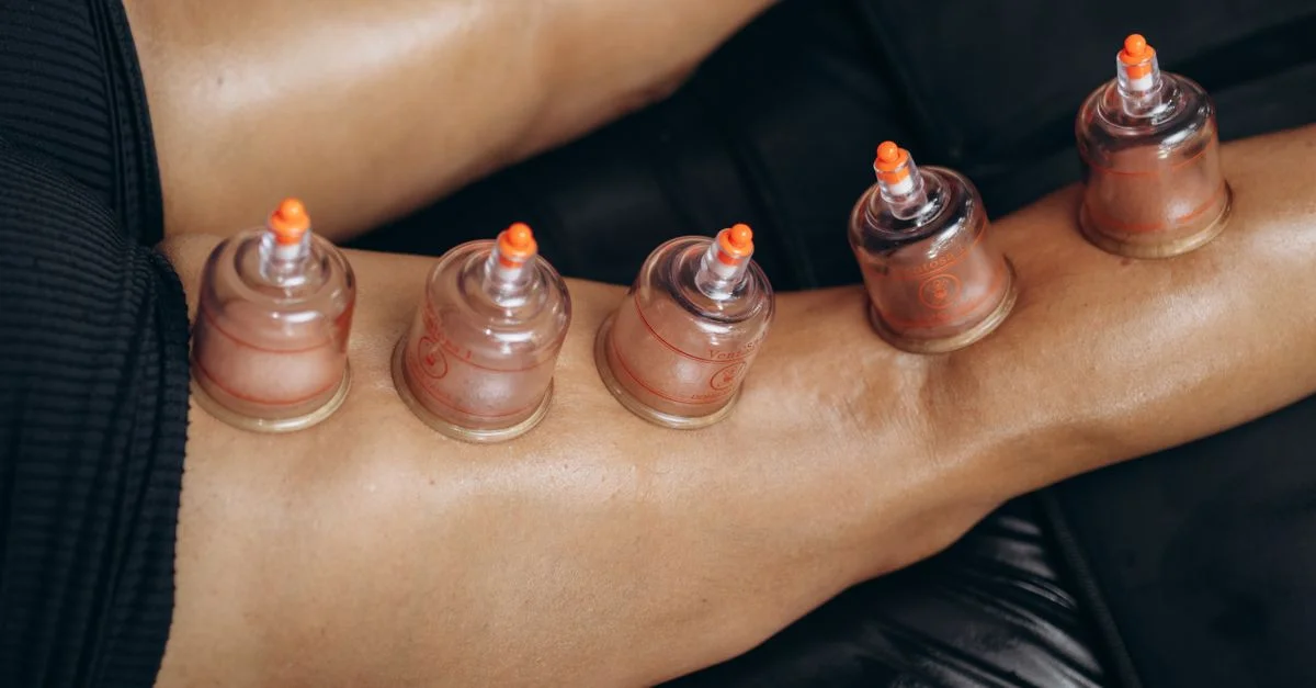 Gros plan sur la thérapie par ventouses sur les jambes, mettant en avant les bienfaits de la guérison naturelle et de la récupération.